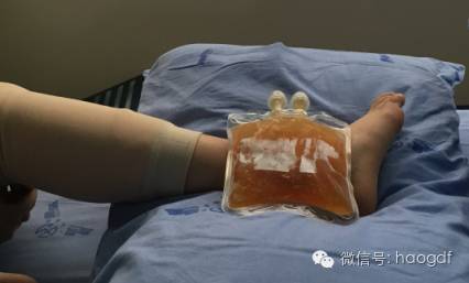 踝关节扭伤的紧急处理方法，转给爱运动的朋友们~~