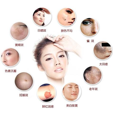 激光祛斑真的会反弹吗,激光脱毛和激光祛斑一样的原理吗