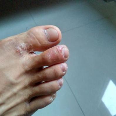分享给大家几个治脚气小妙招，学会一招足够用