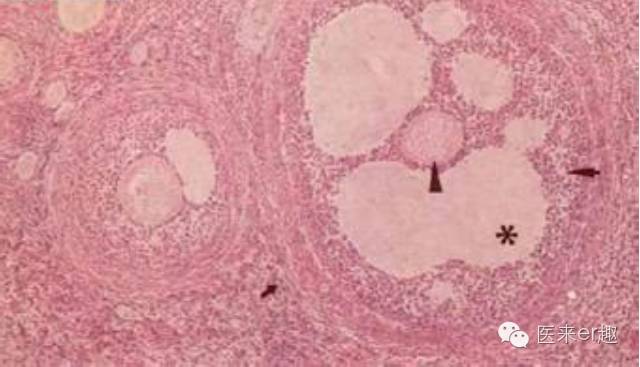 扁卵泡能怀孕吗,促排两个优势卵泡怀孕几率大吗