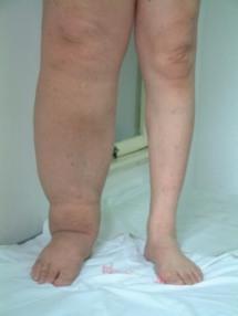 90后艺人徐婷去世原因,艺人徐婷淋巴癌症状