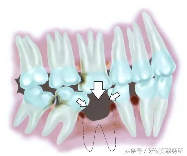 吃肉老塞牙有什么好的办法解决,吃肉老塞牙什么原因