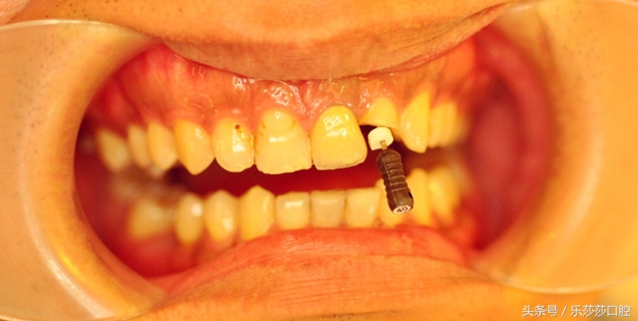 一根针扎进眼珠里会怎么样,一根针放进什么地方容易熔化