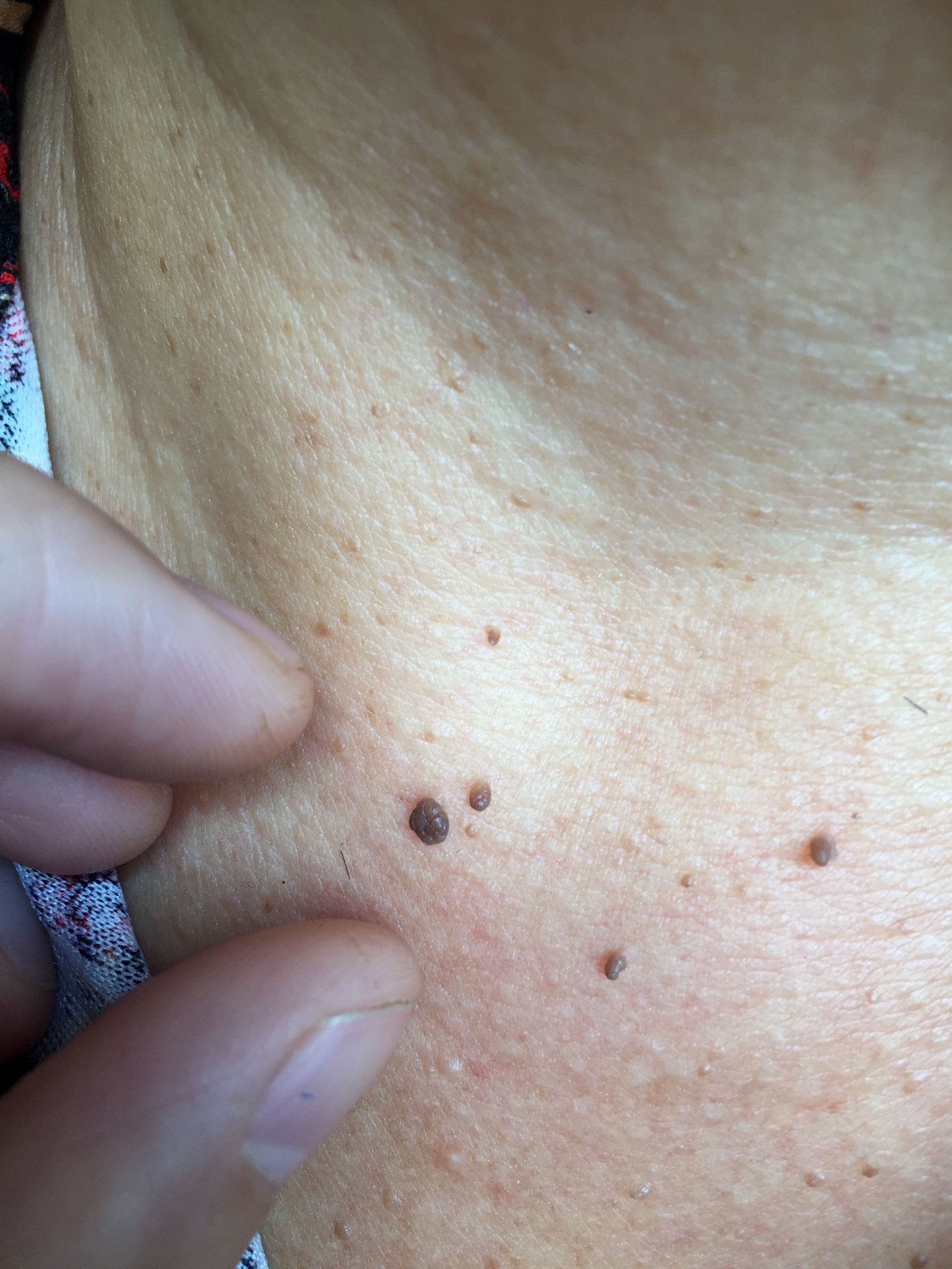 怀孕后脖子上和腋窝长了特别多的“小瘊子”，应该怎么办呢？