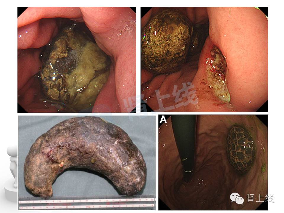 吃山楂取出胃结石,吃10个山楂胃结石有多少