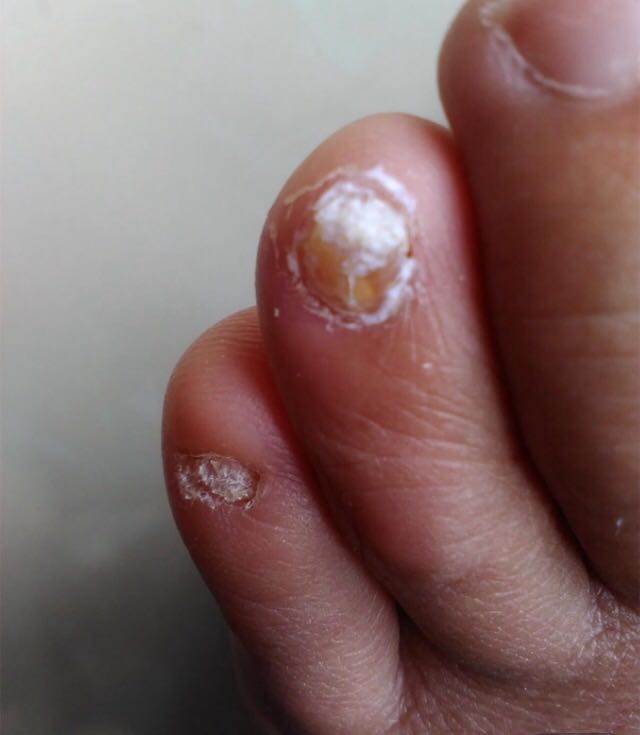 两岁指甲脱落怎么看是不是灰指甲,儿童手指指甲边缘和肉分离怎么办