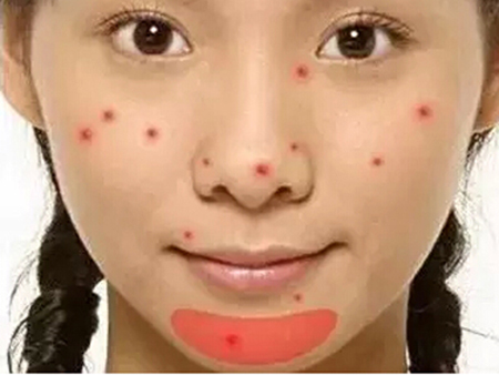 脸上长痘部位解析,脸上长痘位置与脏器对照