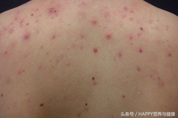 皮肤科怎么治疗长疮,皮肤疮的症状有哪些