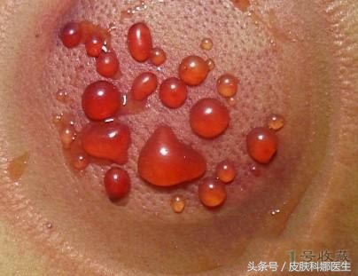 拔火罐结果拔出满身大泡,拔火罐拔出的是瘀血吗