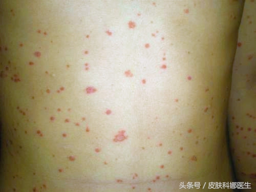 感冒发烧后身上起红疹,感冒发烧完身上长了一身牛皮癣