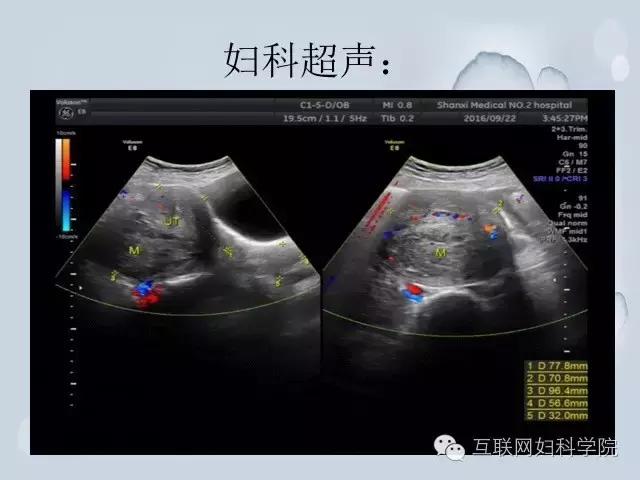 郝敏教授手术直播上线，两台妇科腹腔镜手术!（含视频）
