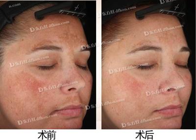 油性皮肤长痘痘用什么药,经常长痘痘经常出油还有痘印