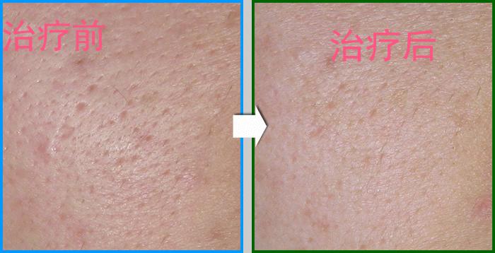 油性皮肤长痘痘用什么药,经常长痘痘经常出油还有痘印