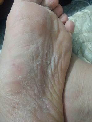 分享给大家几个治脚气小妙招，学会一招足够用