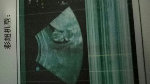 切完阑尾又切宫颈息肉，NT宝宝还是长得健健康康的