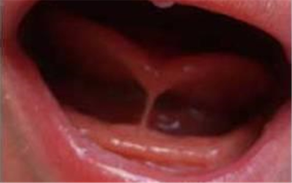 宝宝w型舌1岁半,宝宝w型舌中医辨证