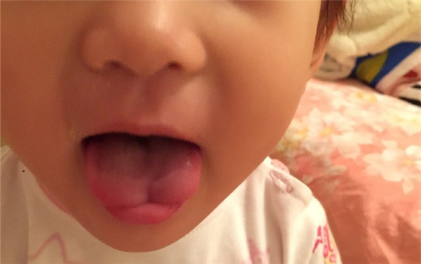 宝宝w型舌1岁半,宝宝w型舌中医辨证