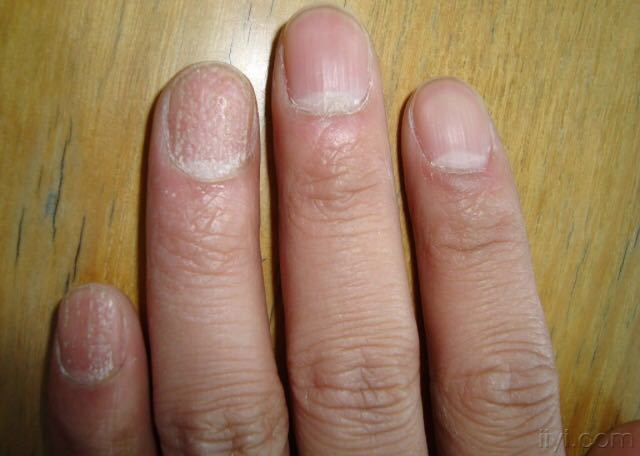 两岁指甲脱落怎么看是不是灰指甲,儿童手指指甲边缘和肉分离怎么办