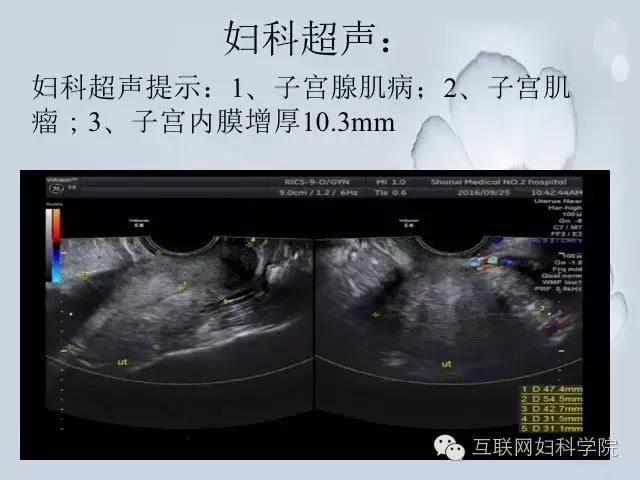 郝敏教授手术直播上线，两台妇科腹腔镜手术!（含视频）