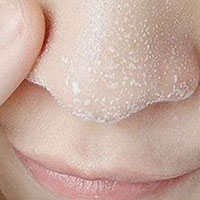 *疮痤**“病因、治疗、预防”这里都有，你不看就错过了！