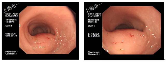 直肠有哪几种情况需要手术,直肠病变esd手术指南
