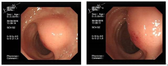 直肠有哪几种情况需要手术,直肠病变esd手术指南