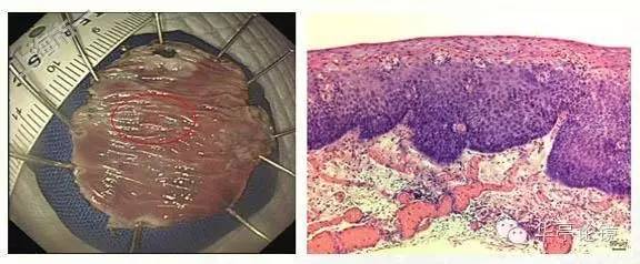 6个精彩病例带你领略早期食管癌的内镜下诊治