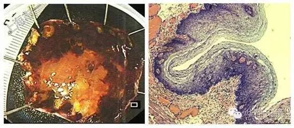 6个精彩病例带你领略早期食管癌的内镜下诊治