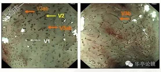 6个精彩病例带你领略早期食管癌的内镜下诊治