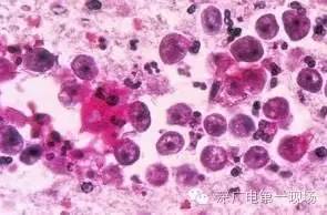 你听说过“吃脑虫”吗？男子患病十几天病逝...原来就因为他做了这件事，大连的小伙伴也要当心！