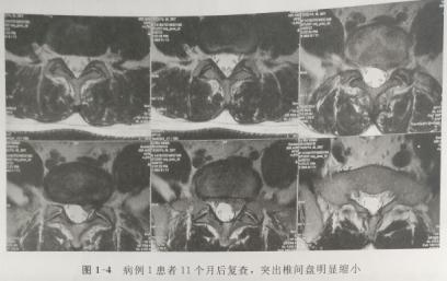 腰椎间盘突出可以练瑜伽吗,腰椎间盘突出可以做什么运动