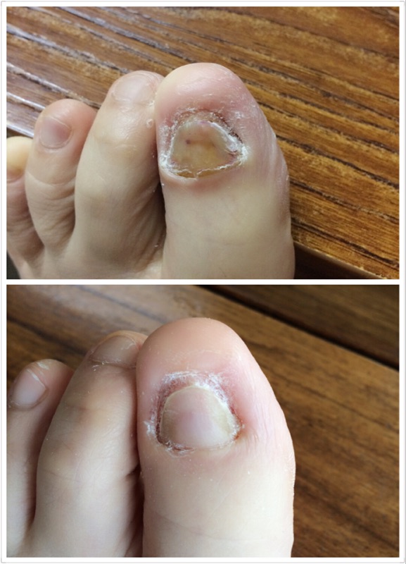 有灰指甲有什么影响吗,有灰指甲是不是会脚趾头痛
