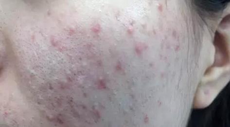 下巴长痘痘怎么治才能彻底除根,长痘痘怎么才能彻底治好