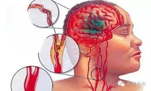 讲解脑血栓疾病的4大预防绝招,脑血栓患者秋天要关注什么