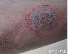 小苏打水洗湿疹有效果吗,小苏打治湿疹的最佳方法