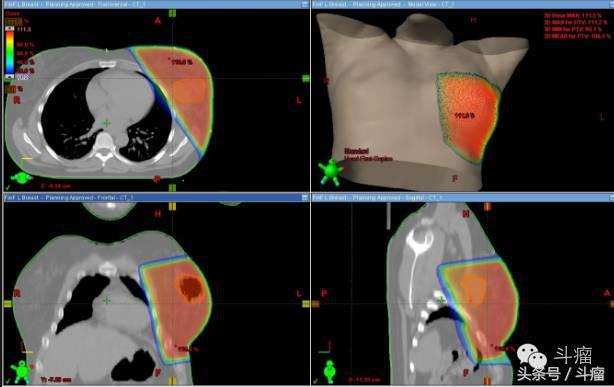 免疫细胞治疗癌症获诺贝尔奖,质子放疗治癌细胞