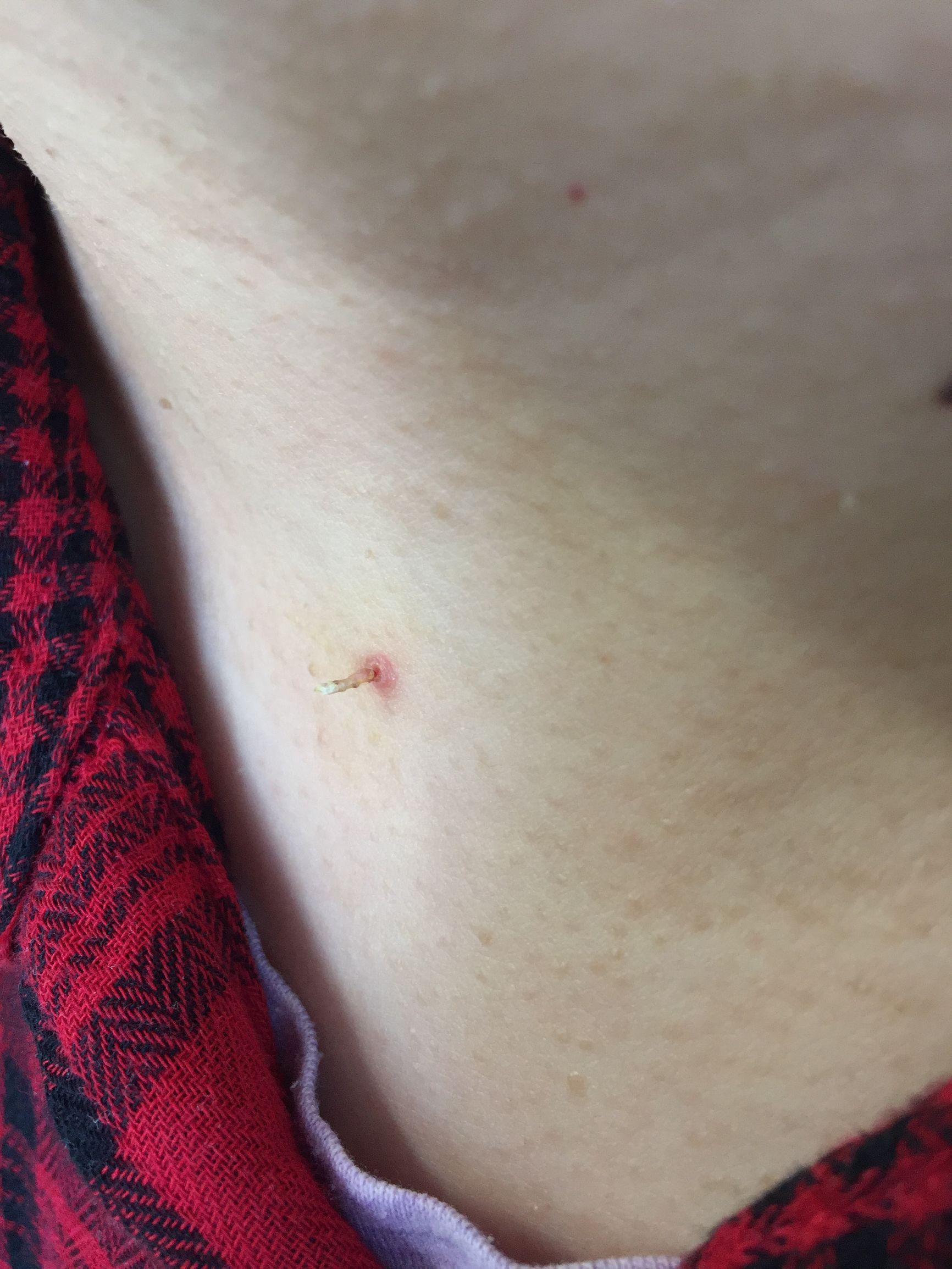 怀孕后脖子上和腋窝长了特别多的“小瘊子”，应该怎么办呢？