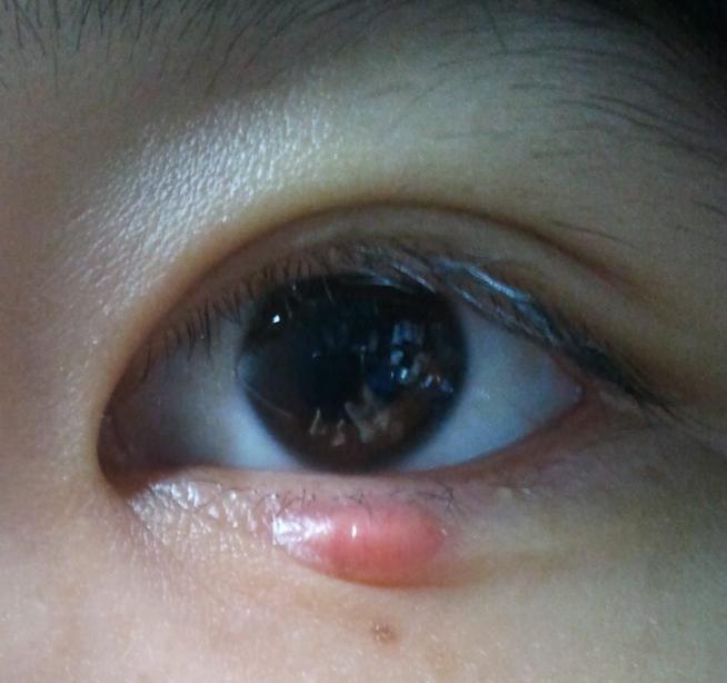 得了麦粒肿不用担心，中医治疗有秘诀