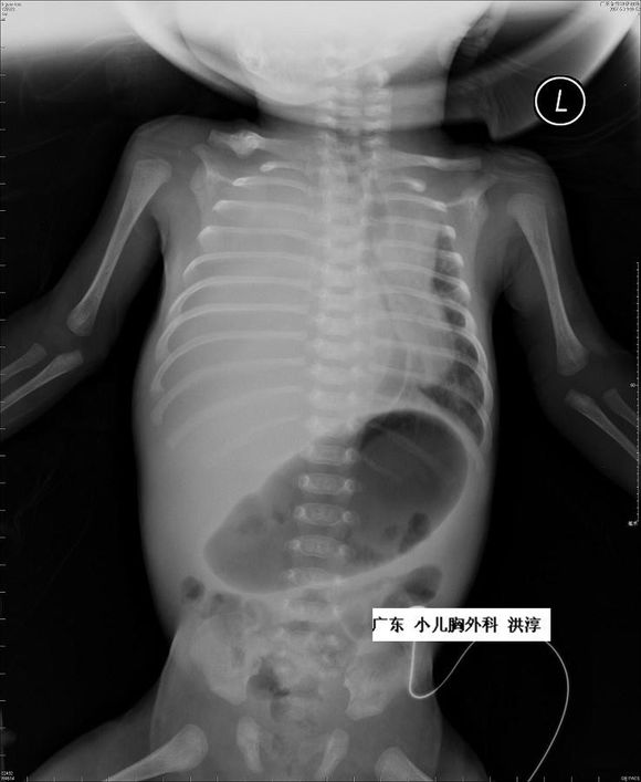 胎儿胸腔积液一般是哪里畸形,胎儿胸腔积液孕妈妈要关注什么