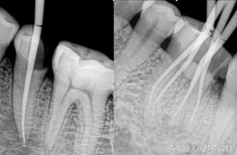 一根针扎进眼珠里会怎么样,一根针放进什么地方容易熔化