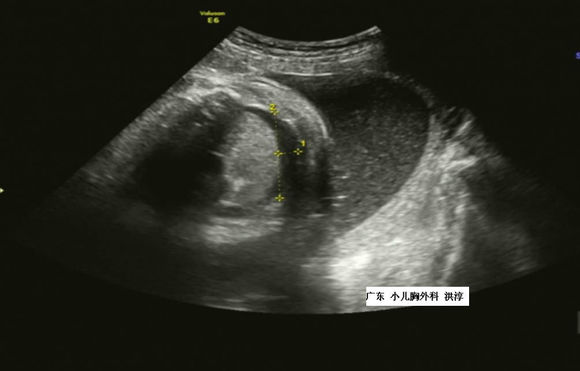 胎儿胸腔积液一般是哪里畸形,胎儿胸腔积液孕妈妈要关注什么