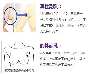 产后副乳有疙瘩是堵奶了吗,产后副乳是淋巴结堵了吗