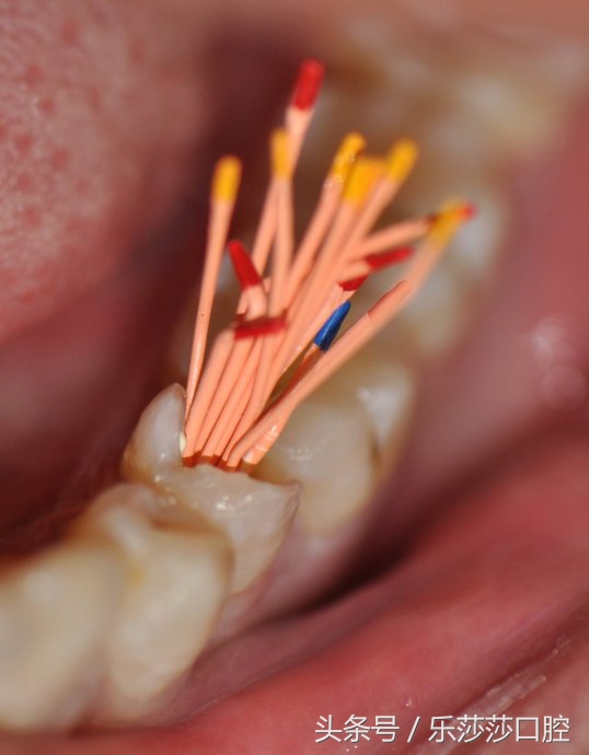 一根针扎进眼珠里会怎么样,一根针放进什么地方容易熔化