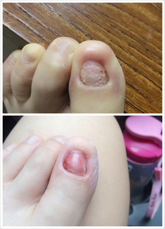 有灰指甲有什么影响吗,有灰指甲是不是会脚趾头痛