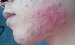 *疮痤**“病因、治疗、预防”这里都有，你不看就错过了！