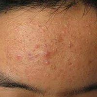 *疮痤**“病因、治疗、预防”这里都有，你不看就错过了！