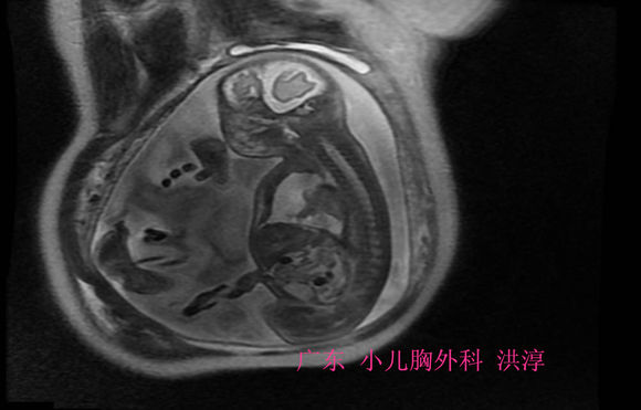 胎儿胸腔积液一般是哪里畸形,胎儿胸腔积液孕妈妈要关注什么