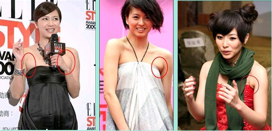 产后副乳有疙瘩是堵奶了吗,产后副乳是淋巴结堵了吗