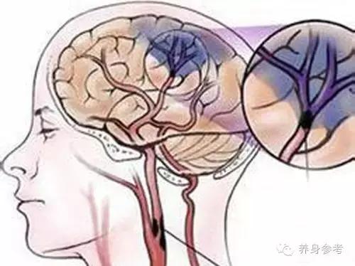 讲解脑血栓疾病的4大预防绝招,脑血栓患者秋天要关注什么