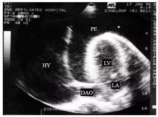超声诊断心包腔积液,心包积液的超声诊断与鉴别